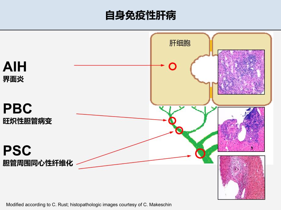 自免肝慕尼黑肝病中心教学文案_第2页