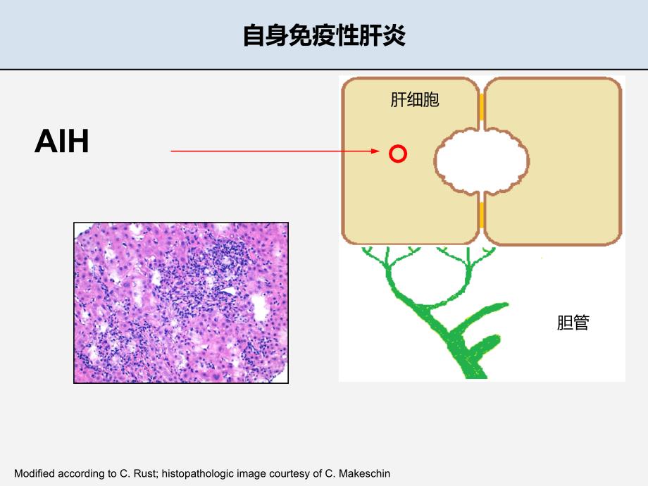 自免肝慕尼黑肝病中心教学文案_第3页