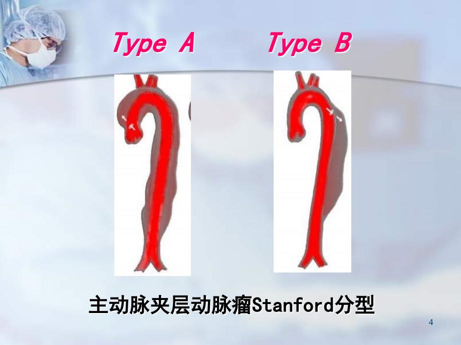 烟囱技术在胸主动脉夹层动脉瘤腔内治疗体会1_第4页