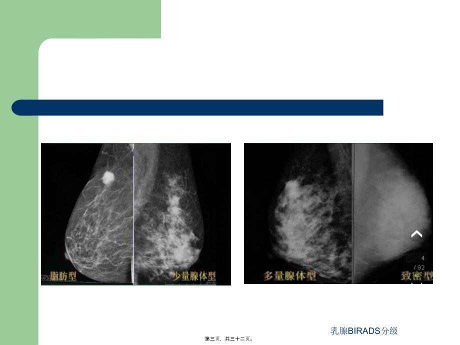 乳腺BIRADS分级课件_第3页