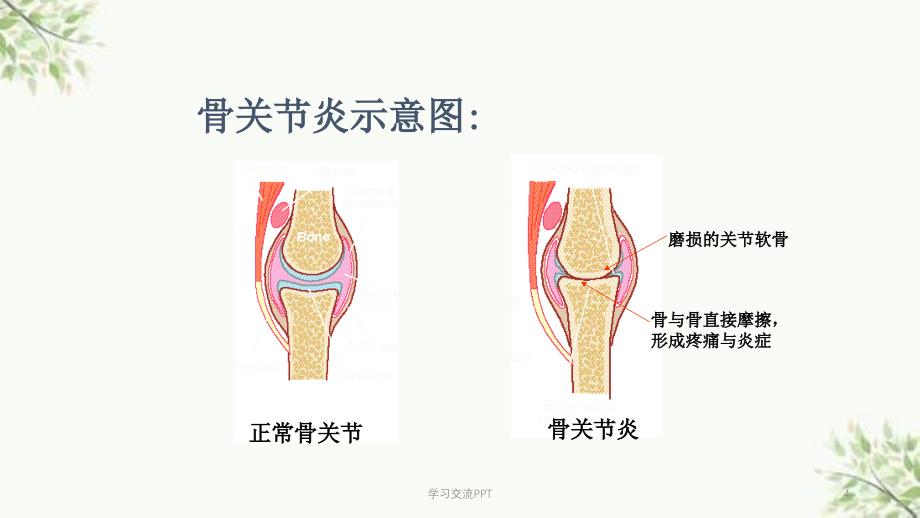 骨性关节炎讲课课件_第4页