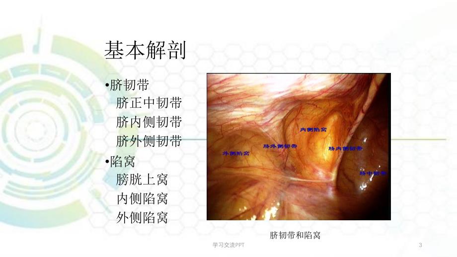 TAPP手术技巧课件_第3页