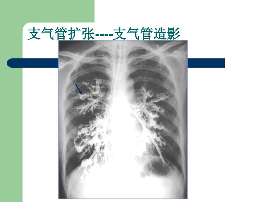 医学影像学：肺炎、肺脓肿和肺结核_第3页