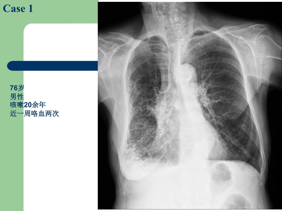 医学影像学：肺炎、肺脓肿和肺结核_第4页