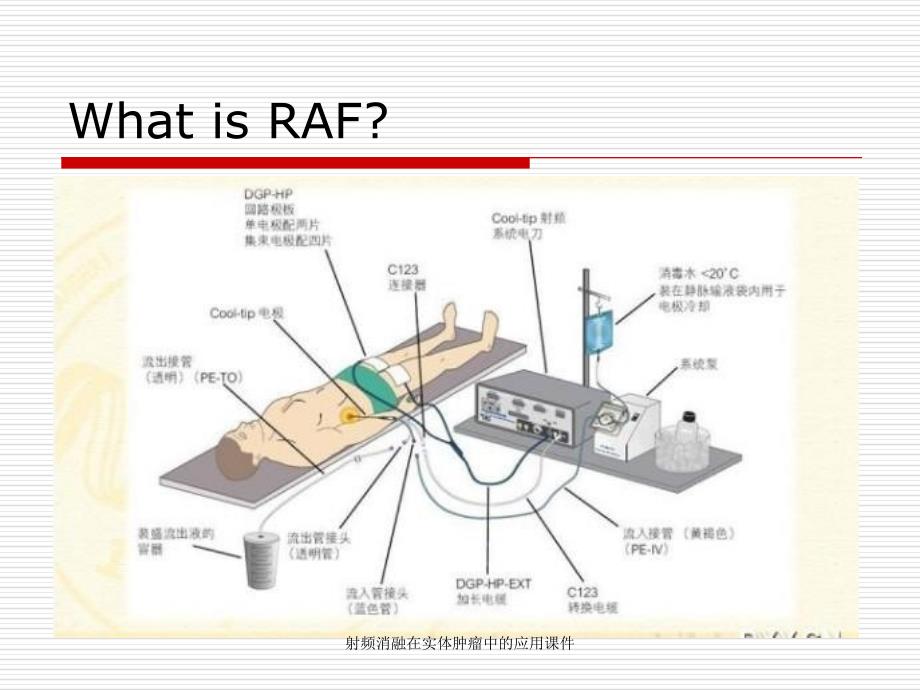 射频消融在实体肿瘤中的应用课件_第2页