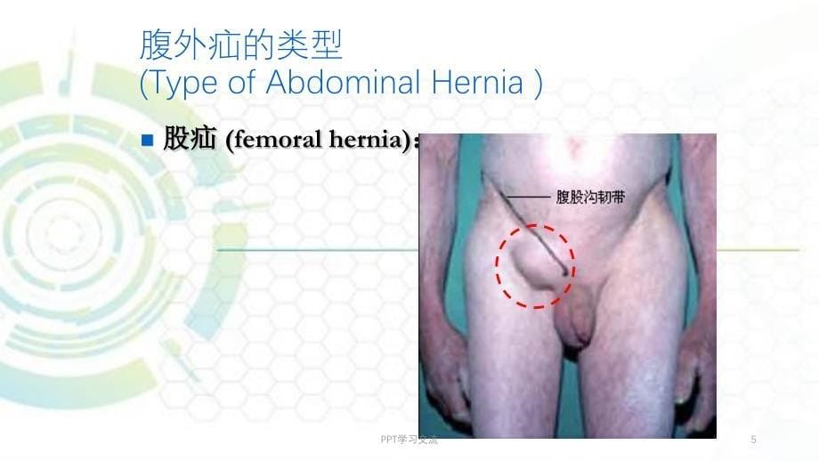 腹股沟疝1ppt课件_第5页