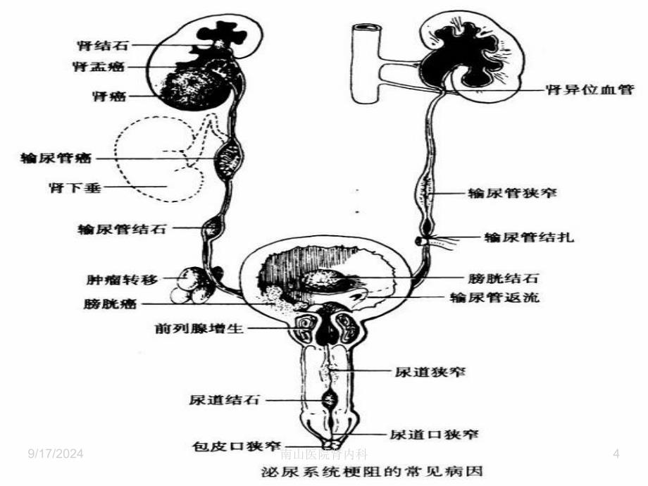 尿路感染病人护理-描述课件_第4页