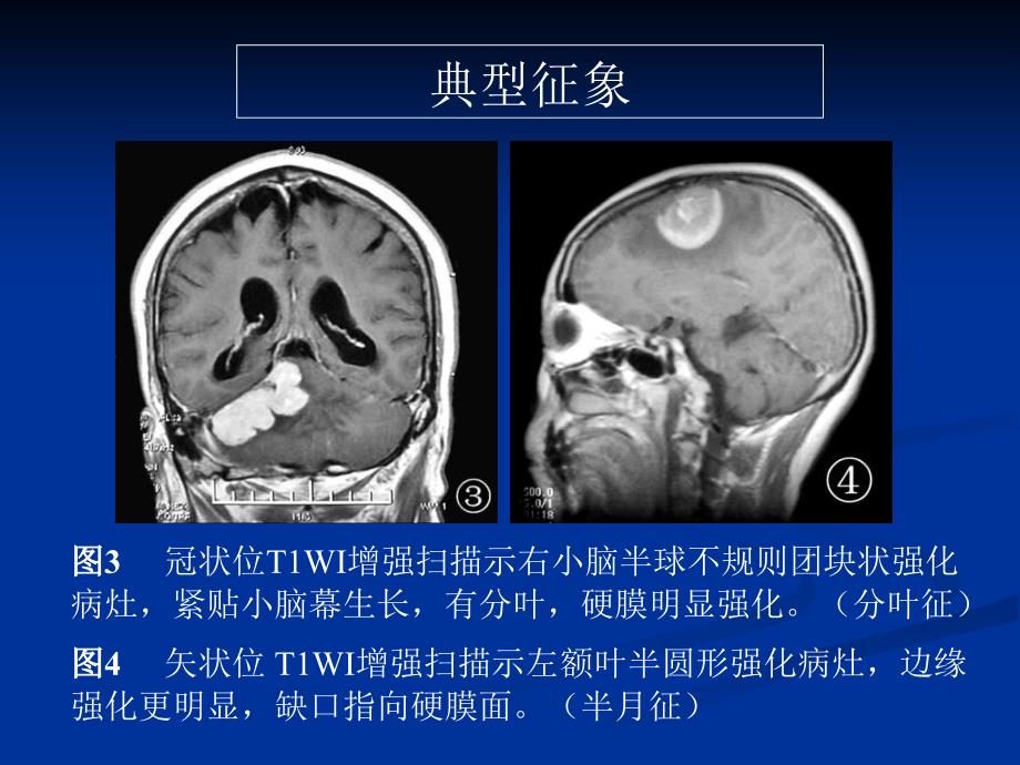 脑部原发性淋巴瘤的MRI诊断_第4页