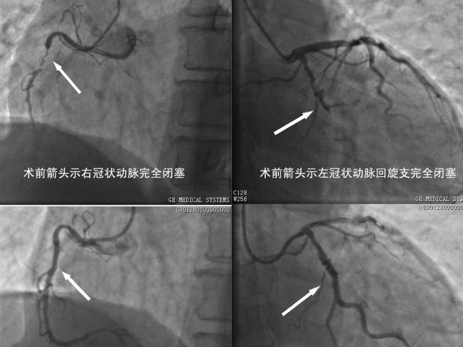 心血管介入手术病人的护理_第4页