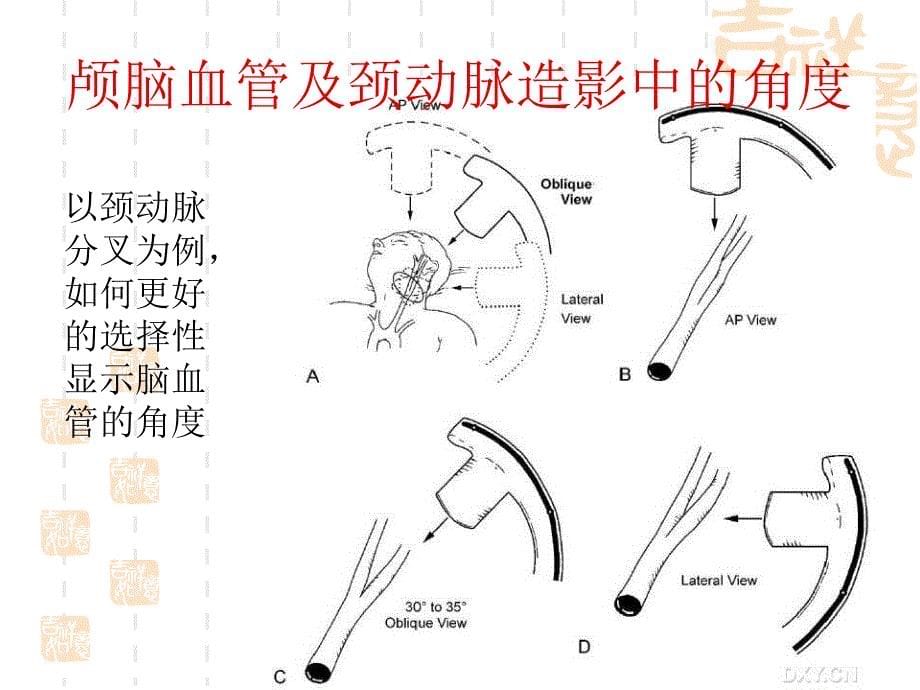 脑血管造影角度选择_第5页