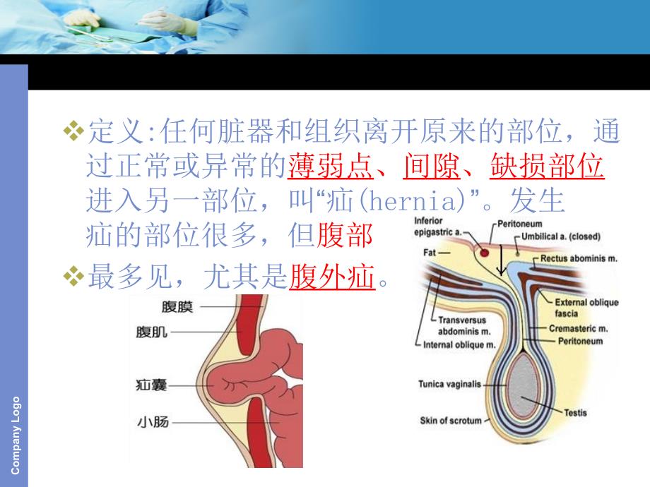 PPT课件腹外疝5723.6.8_第3页