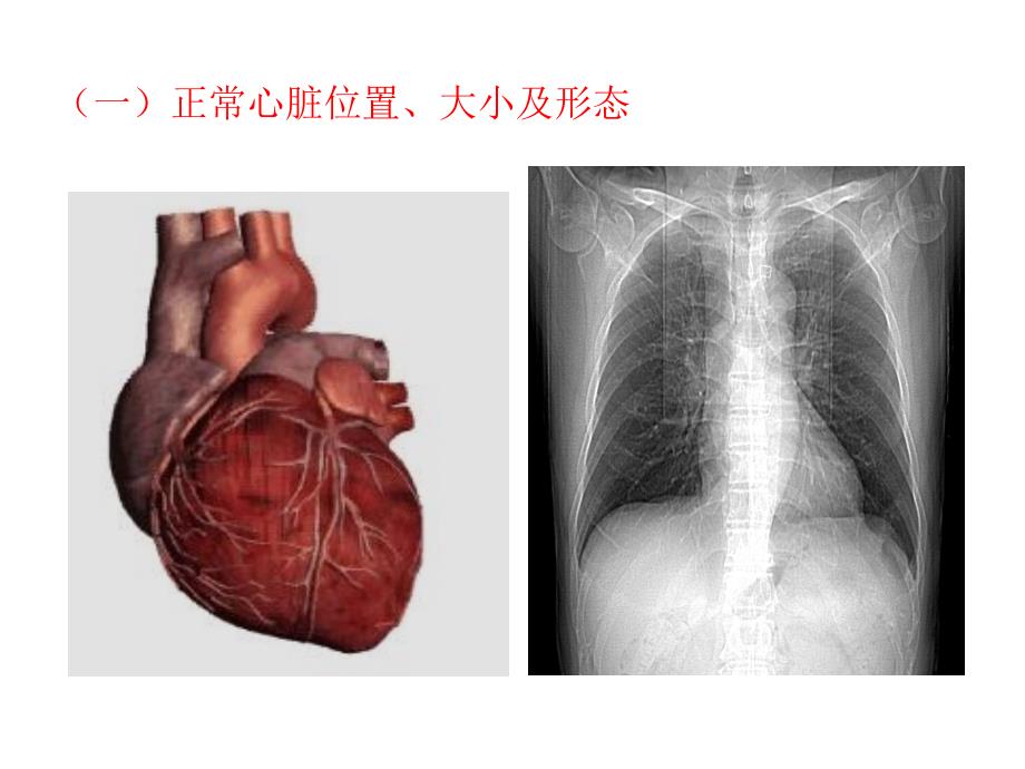 风湿性心脏病心包疾病_第3页