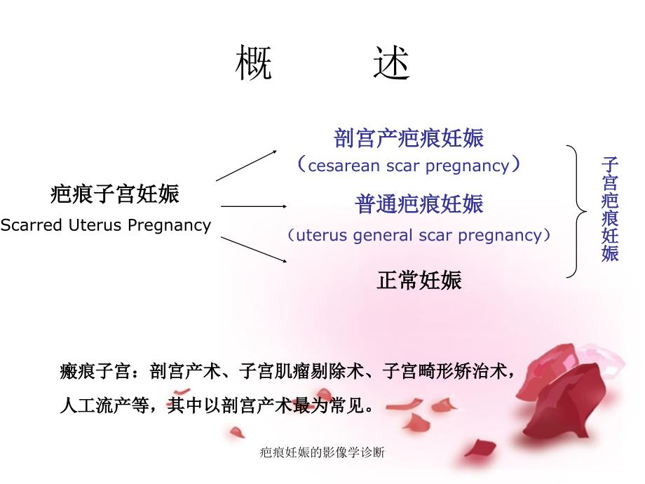 疤痕妊娠的影像学诊断课件_第2页