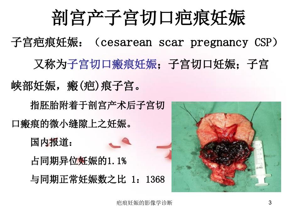 疤痕妊娠的影像学诊断课件_第3页