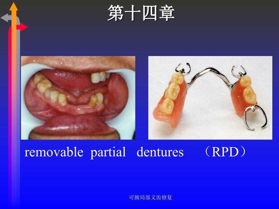 最新可摘局部义齿修复_第1页