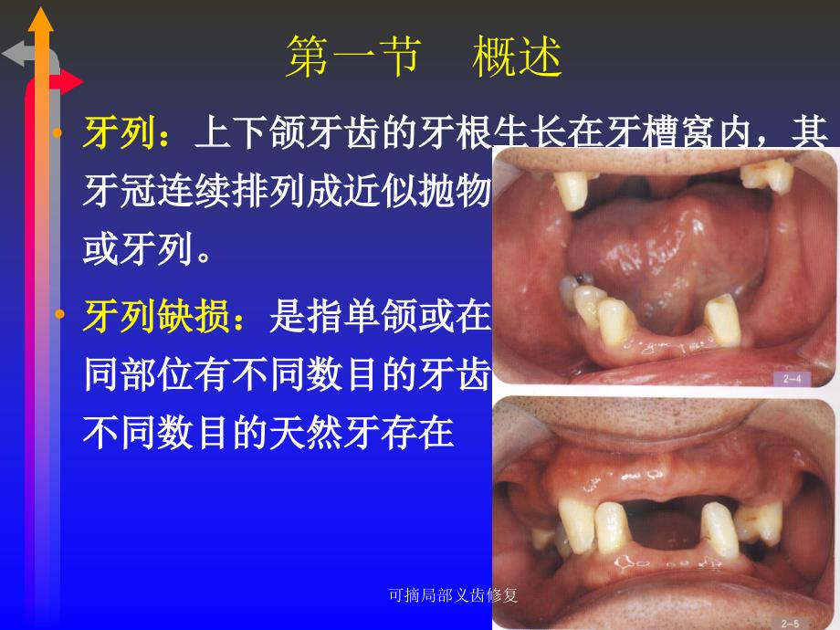 最新可摘局部义齿修复_第3页