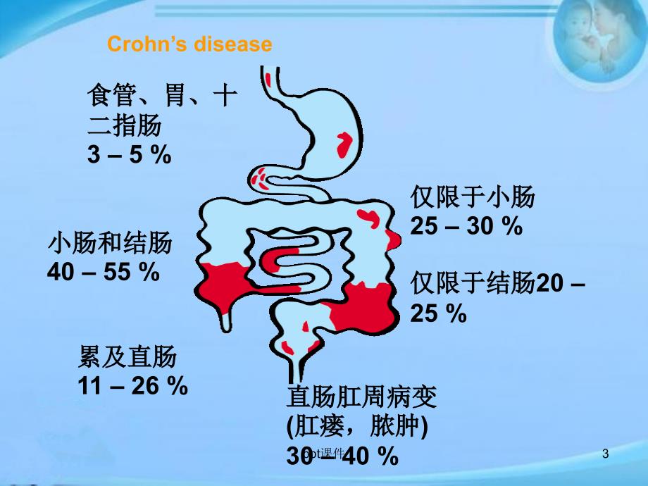 克罗恩病的护理课件_第3页