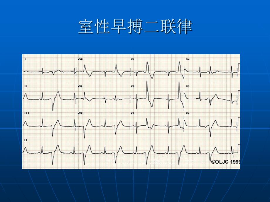 恶性心律失常的识别PPT文档_第4页