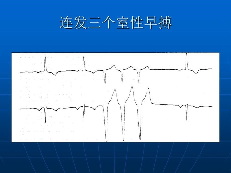 恶性心律失常的识别PPT文档_第5页