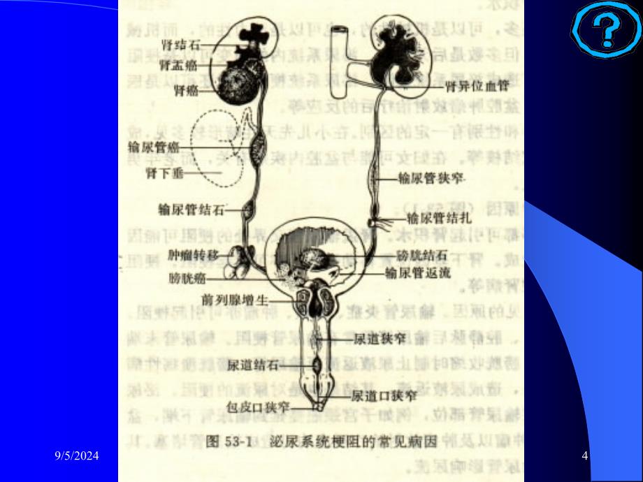 医学专题：泌尿系统梗阻_第4页