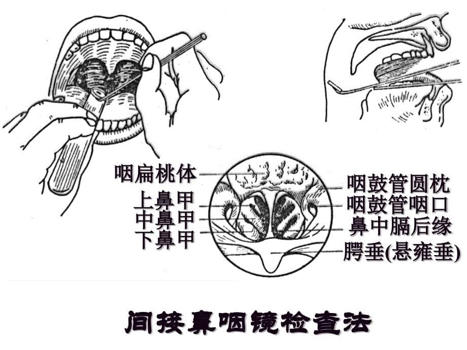 急性化脓性扁桃体炎课件_第5页