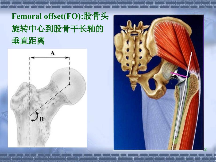 正常髋关节股骨偏心距的影像学研究_第2页