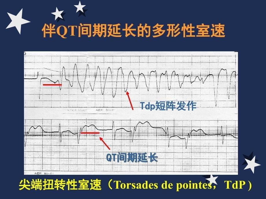 恶性心律失常延安PPT课件_第5页