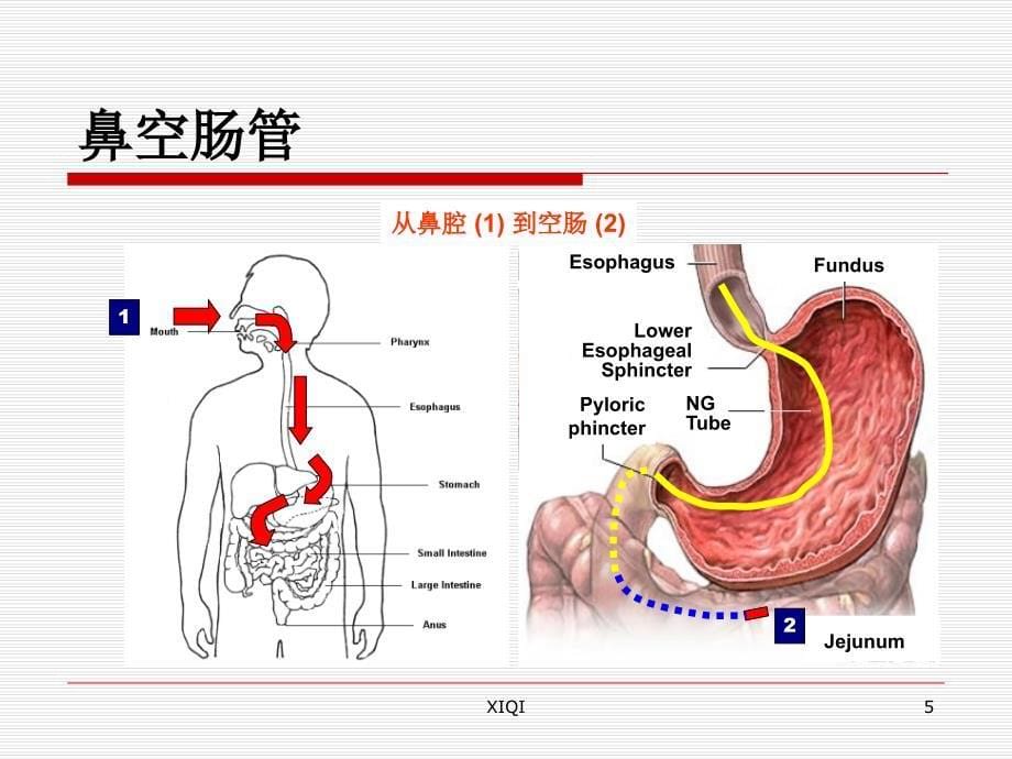 鼻肠管的护理_第5页