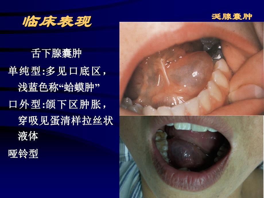 涎腺肿瘤及瘤样病变ppt课件_第4页