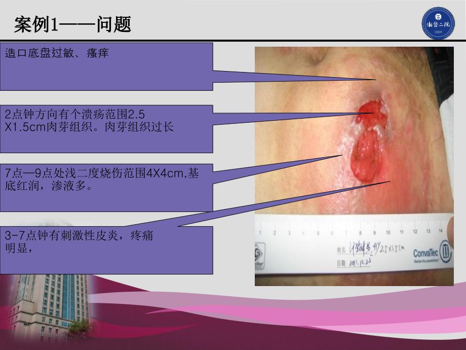 造口护理案例分享_第4页