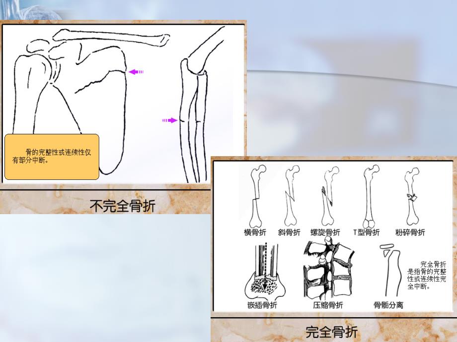 创伤骨折急救PPT课件_第3页