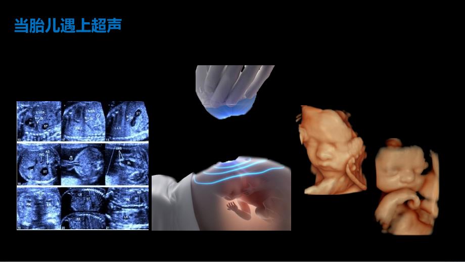 产前超声医学科普演讲课件_第4页