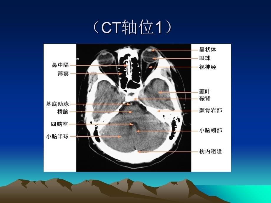 颅脑解剖及颅脑外伤性疾病CT诊断课件_第5页