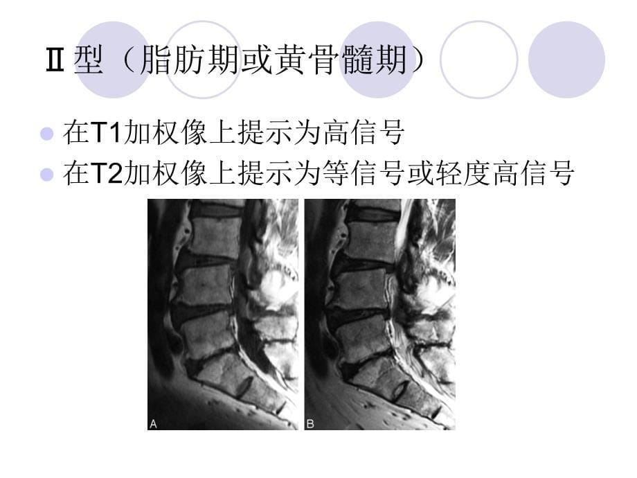 Modic 改变的表现及临床意义_第5页