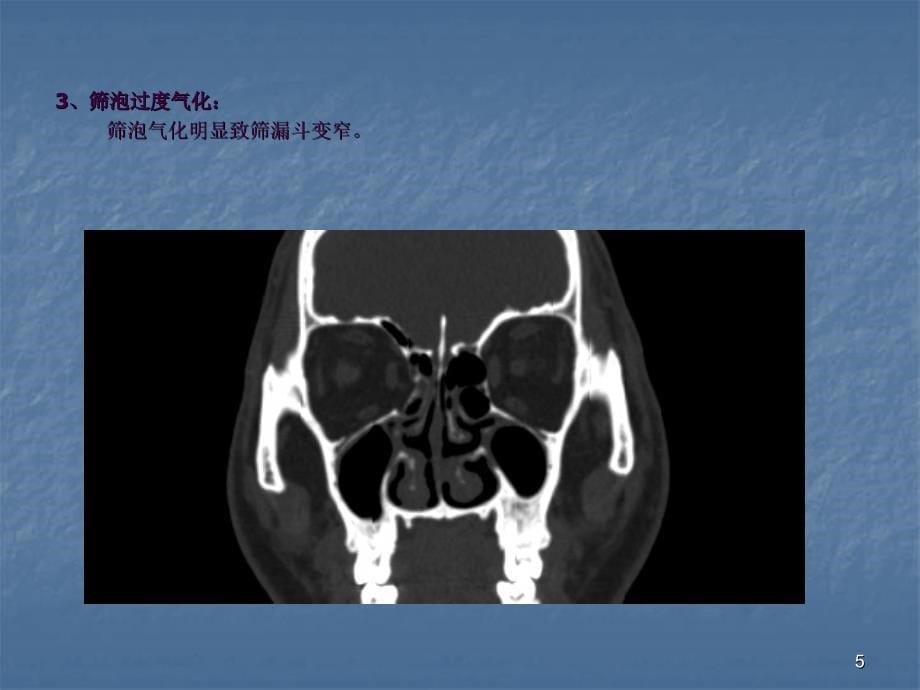 窦口鼻道复合体ppt课件_第5页