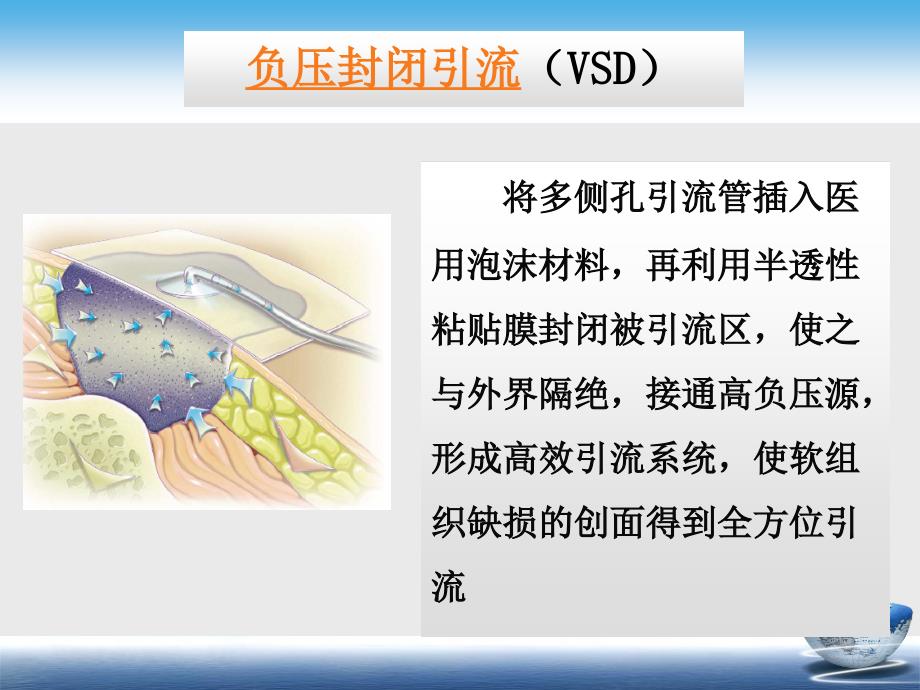 VSD在创修复中_第4页