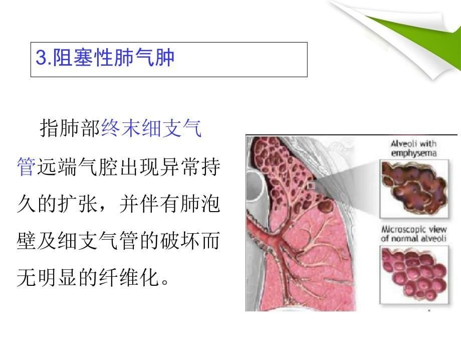 COPD-慢性阻塞性肺气肿解读_第5页