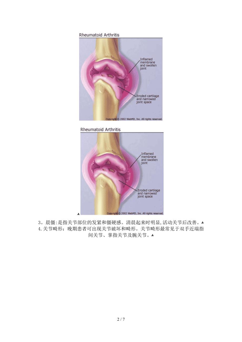 类风湿关节炎病例分析_第2页