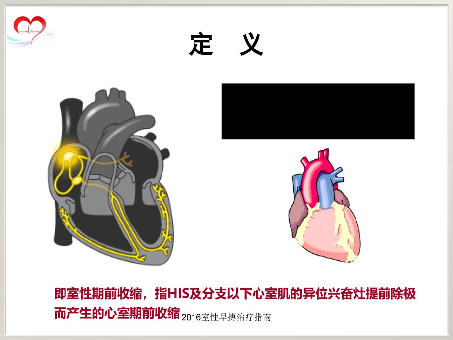 室性早搏治疗指南_第3页