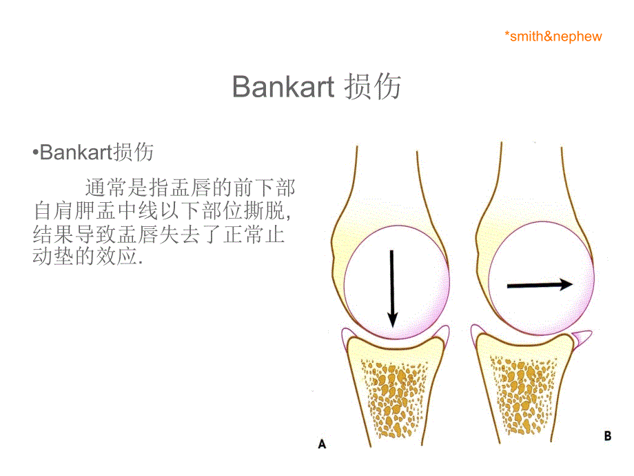 肩关节bankart损伤_第2页