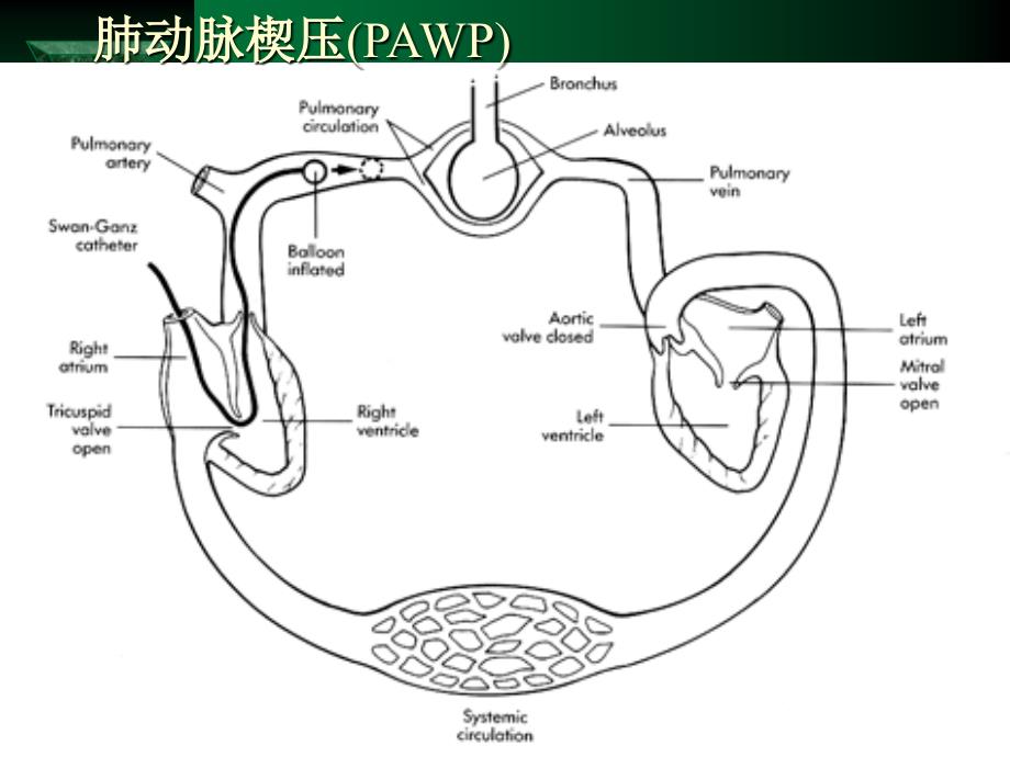 漂浮导管的临床应用_第2页