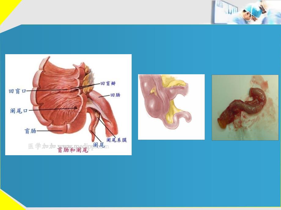 急性阑尾炎的诊断及治疗_第3页