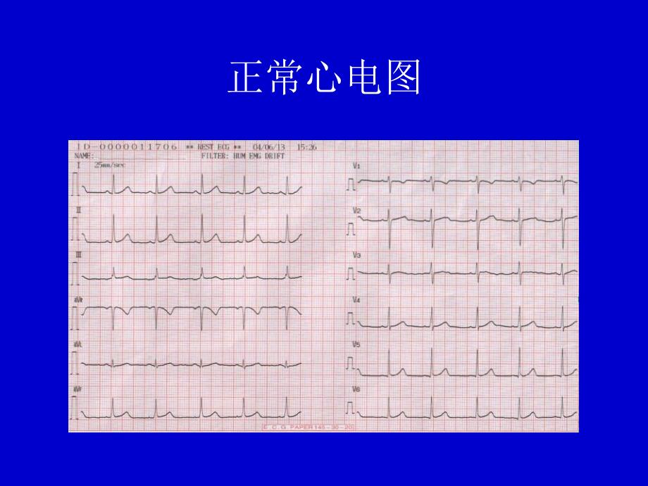 最新心律失常心电图表现PPT课件_第2页