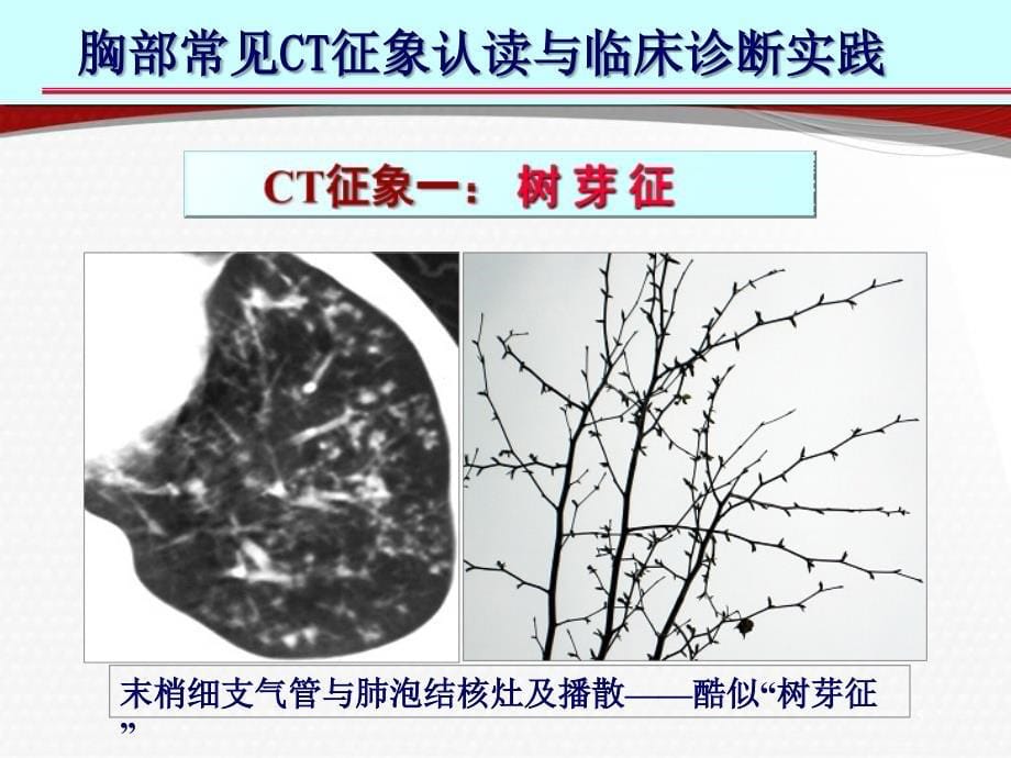 医学PPT课件肺部CT十大征象诊断应用精选课件_第5页