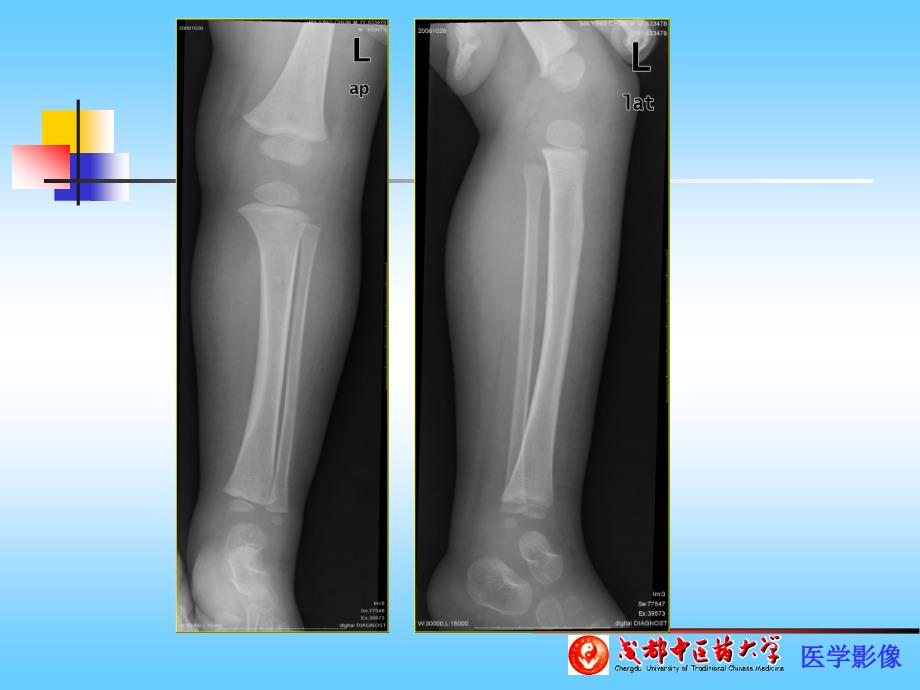 骨关节感染、结核、肿瘤PPT课件.ppt_第3页