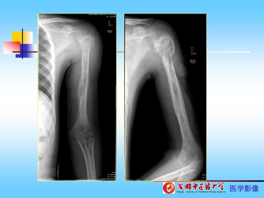 骨关节感染、结核、肿瘤PPT课件.ppt_第5页