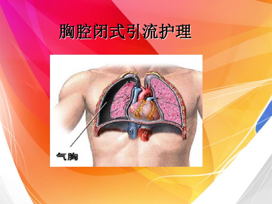 胸腔闭式引流护理ppt_第1页