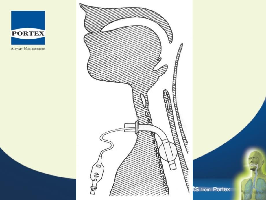 经皮气管切开ppt课件_第3页