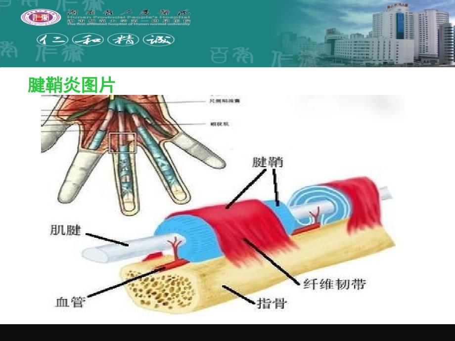 腱鞘炎的预防和护理.ppt_第5页