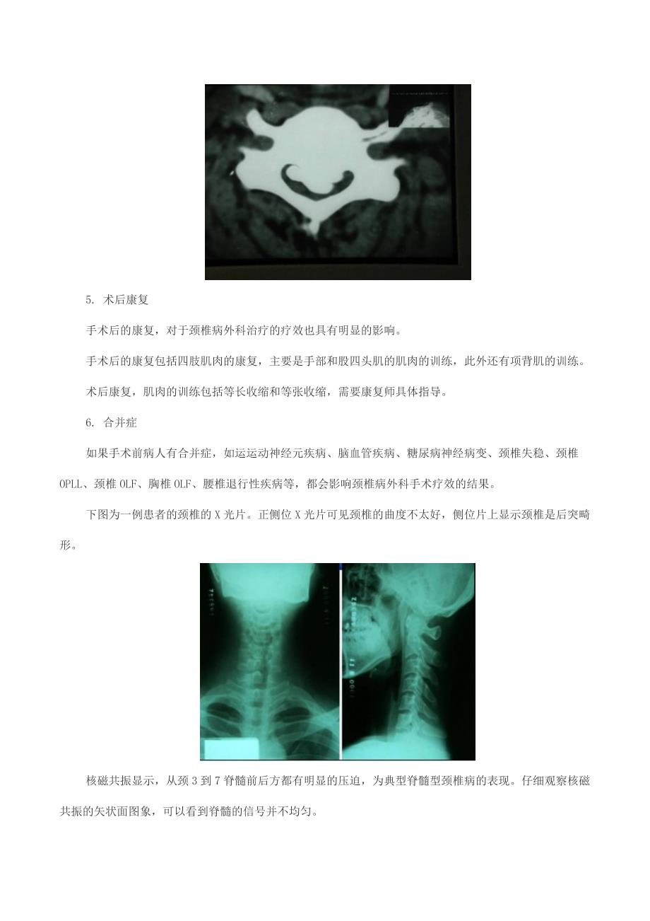 影响颈椎病外科治疗结果的因素.docx_第4页